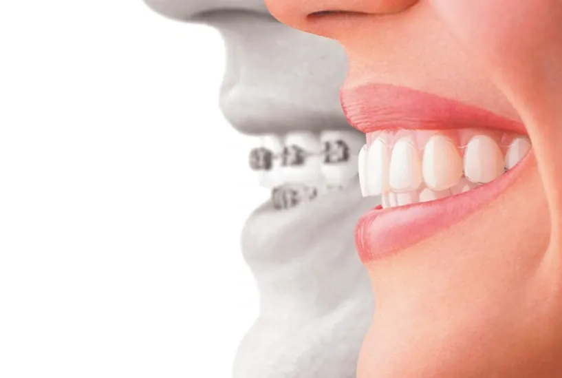 Traditional Braces vs. Sioux Falls Invisalign Clear Aligners