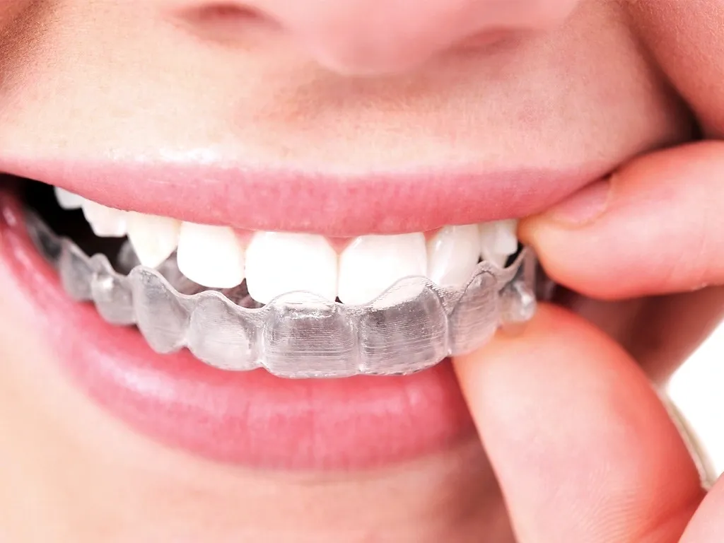 Mail-Order Aligners vs. Invisalign Aligners: What to Know