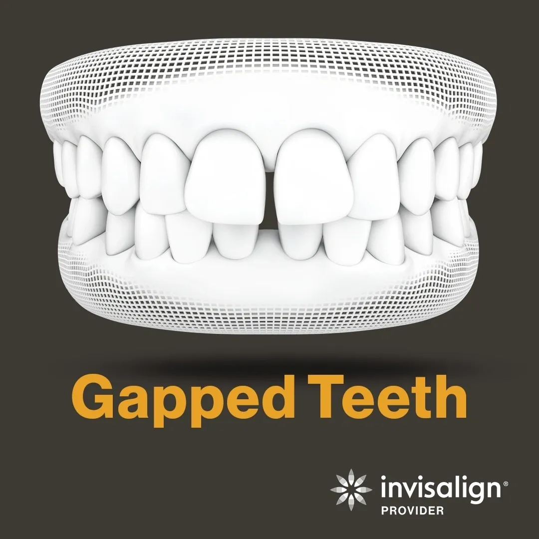Can Invisalign Fix My Gapped Teeth?