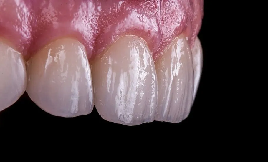 Can You Get Invisible Aligners with Missing Teeth?