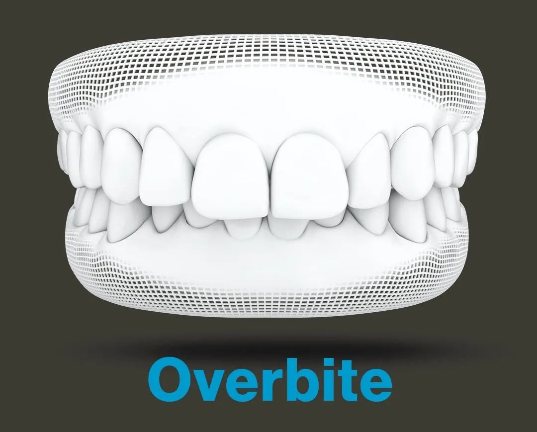 Can Invisalign Clear Aligners Fix An Overbite?