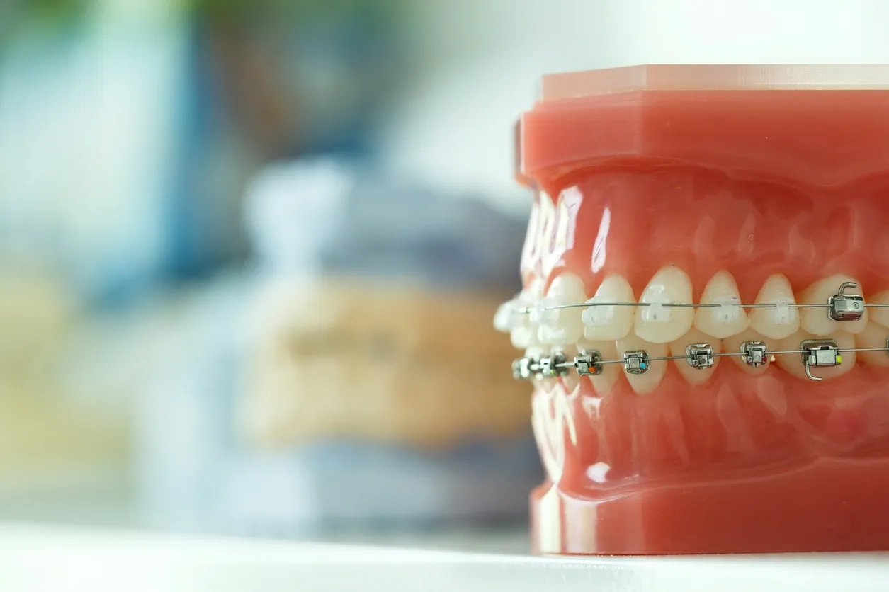 How Orthodontics Works: Braces