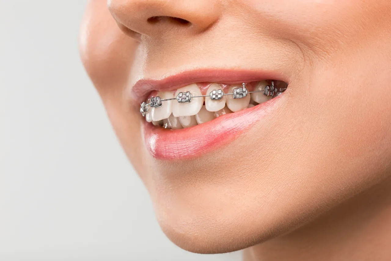 CAN YOU GET BRACES JUST ON YOUR BOTTOM TEETH OR TOP TEETH?